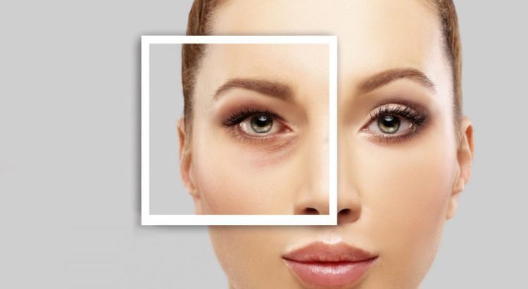 What Is Blepharoplasty?