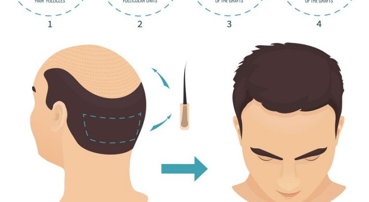 What is FUE Hair Transplant Method?