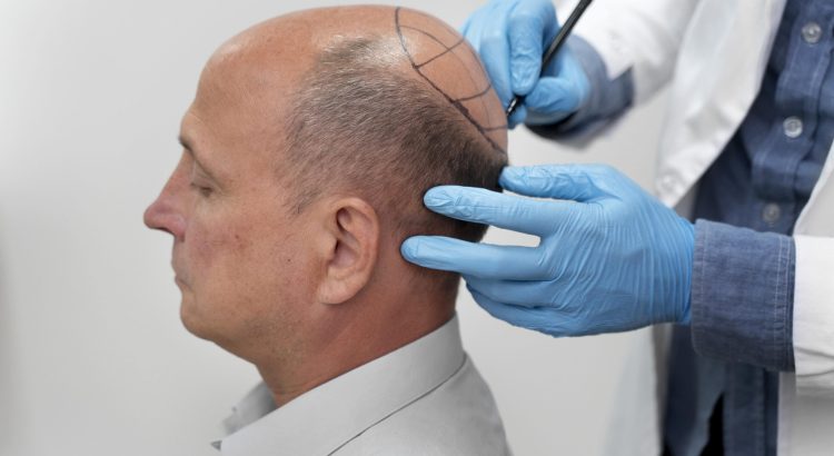 FAQs About FUE Hair Transplantation