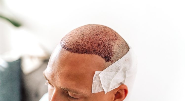 All Details of Hair Transplantation