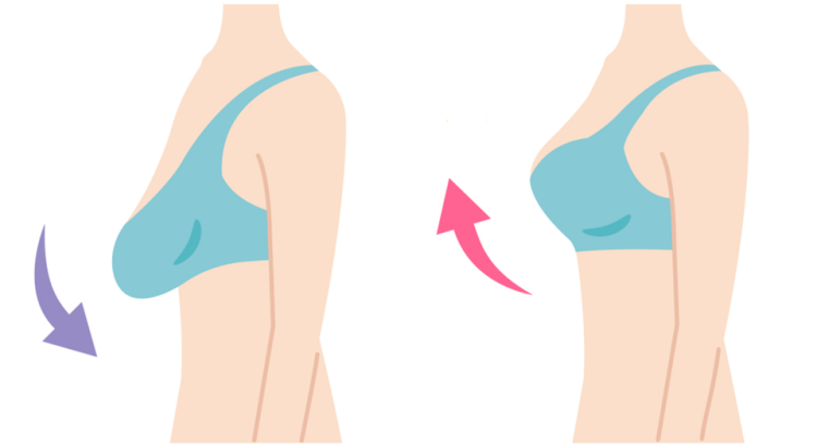 Breast Lift Surgery