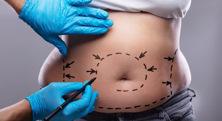 Abdominoplasty Surgery