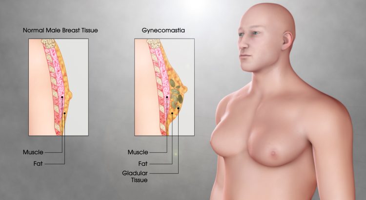 Gynecomastia Surgery