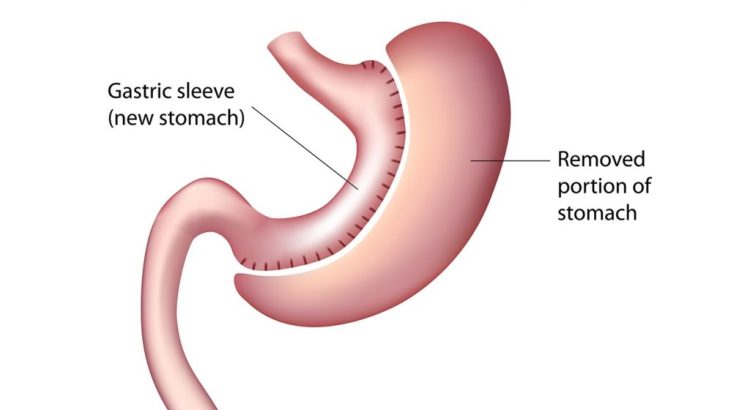 Gastric Sleeve Surgery in Istanbul