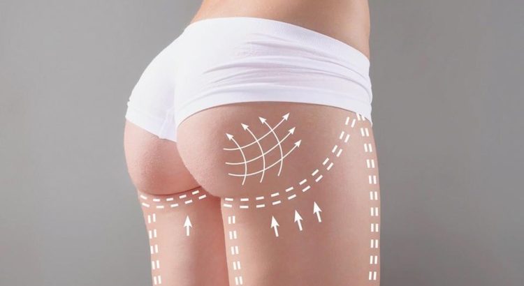 Advantages of Buttock Aesthetics