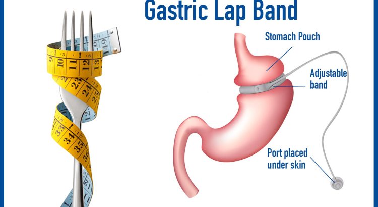 Gastric Band Surgery in Istanbul Turkey All Details