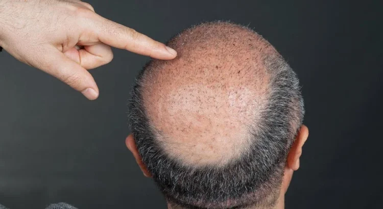 The Benefits of Hair Transplantation