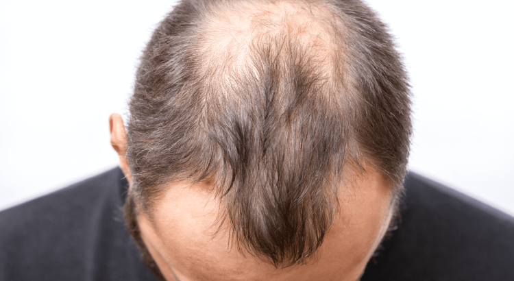 Hair Transplantation FAQs: Everything You Need to Know
