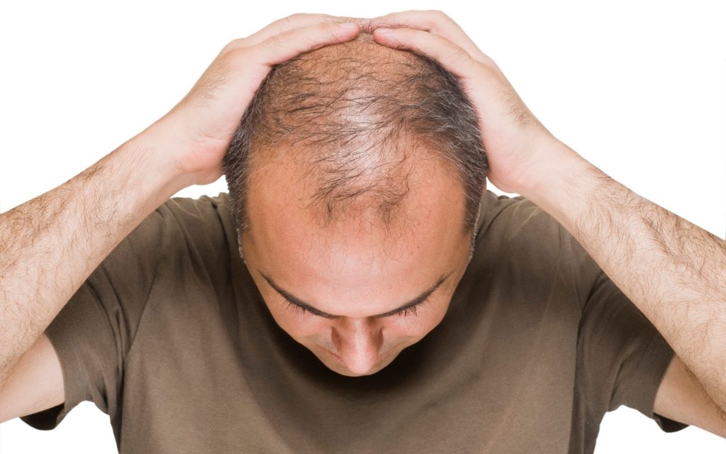 Androgenetic Alopecia Treatment
