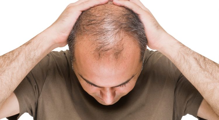 Androgenetic Alopecia Treatment