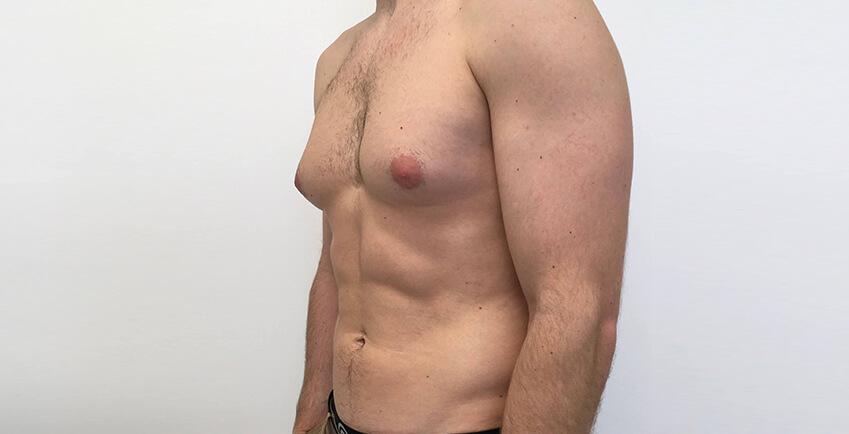 What Is Gynecomastia?