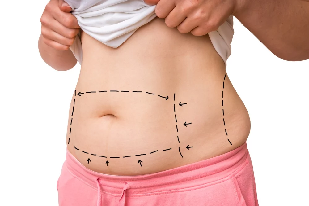 What Is Abdominoplasty Surgery?