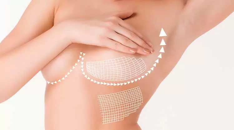 Factors To Consider For Breast Aesthetics