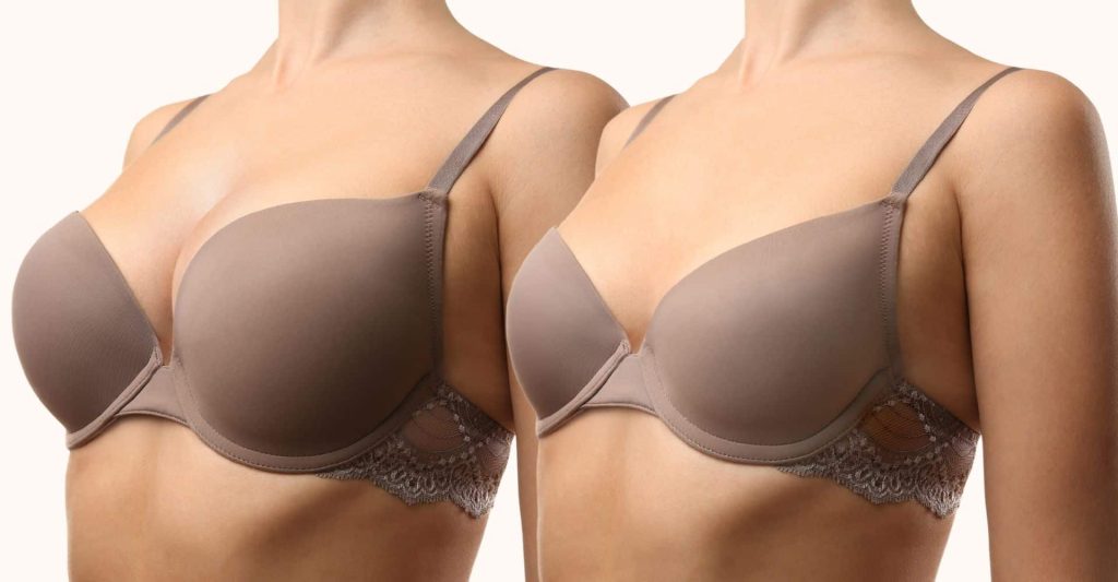 Overview Of Breast Reduction Aesthetics