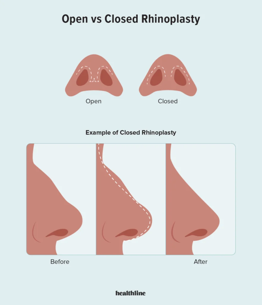 What Is Closed Rhinoplasty?