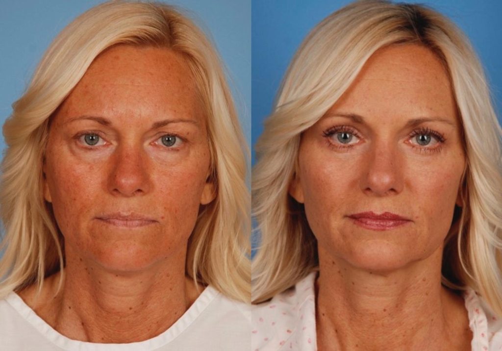 What Is Blepharoplasty?