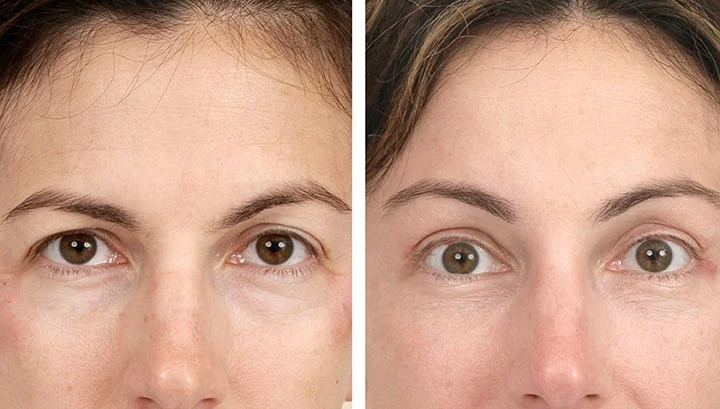 What Is An Eyebrow Lift?