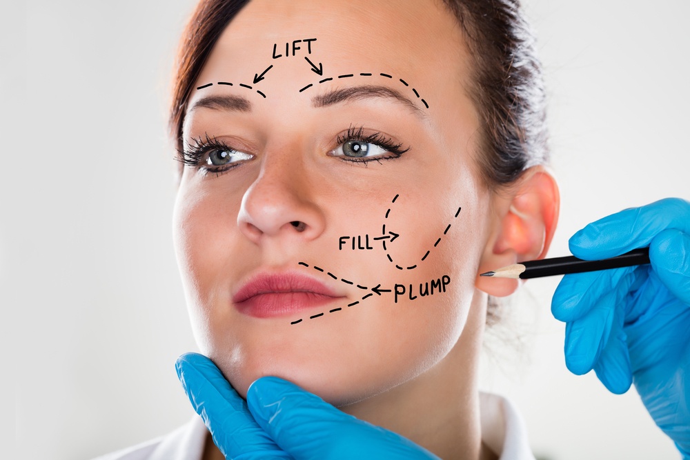 What Is Facelift Surgery?