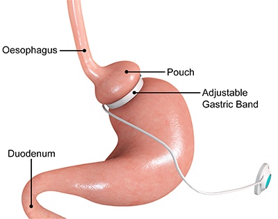 gastric band