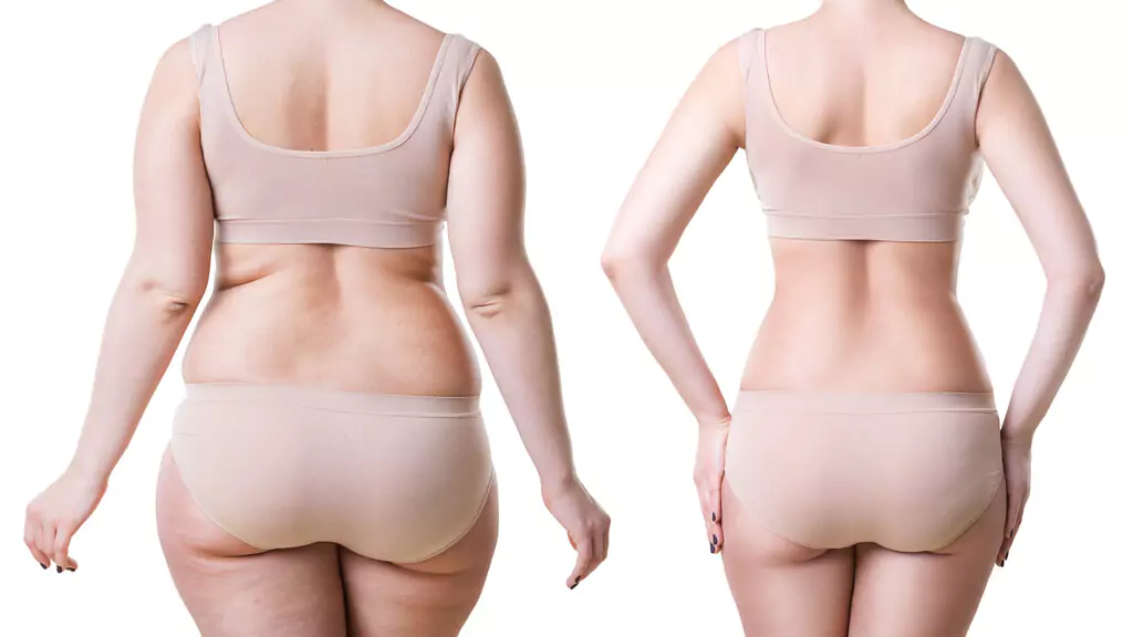 What Is Liposuction Fat Removal?