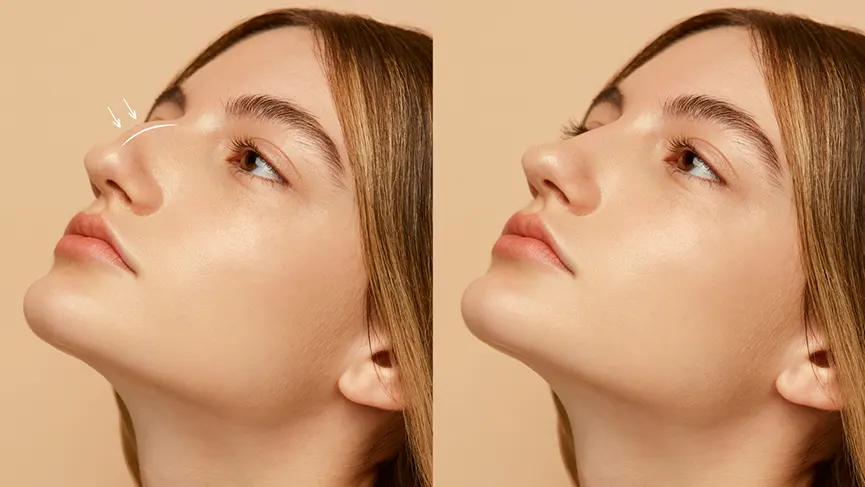 Rhinoplasty result