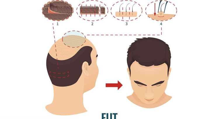 Follicular-Hair-Transplantation