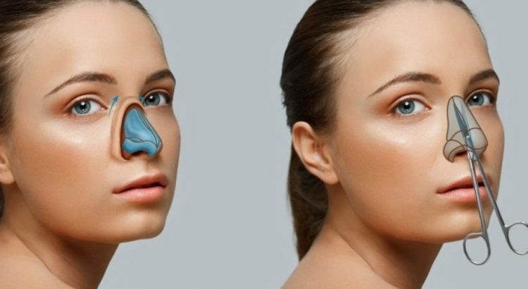 Revision Rhinoplasty in Istanbul