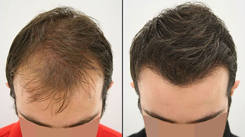 Coraspin - Hair Transplantation