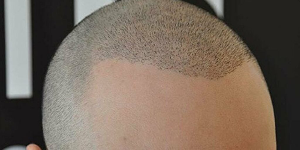 hair transplant