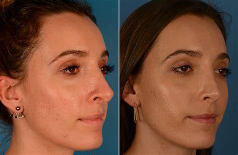 Functional Rhinoplasty: Improving Breathing and Aesthetics