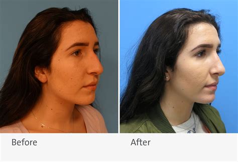 Benefits of Robotic Assisted Surgery in Rhinoplasty
