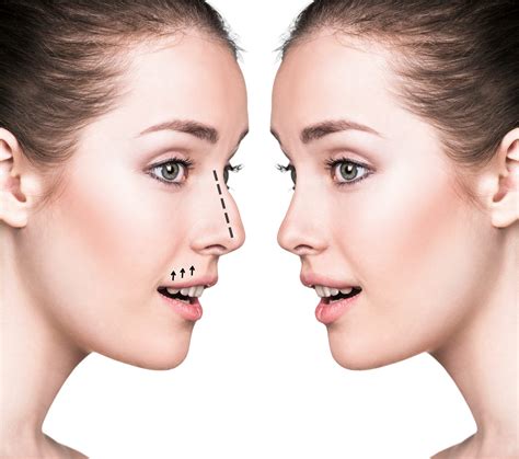 The Psychological Impact of Rhinoplasty Surgery