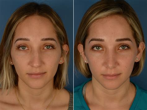 The Psychological Impact of Rhinoplasty Surgery