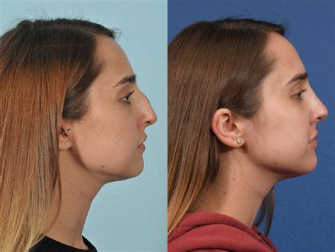 The Psychological Impact of Rhinoplasty Surgery