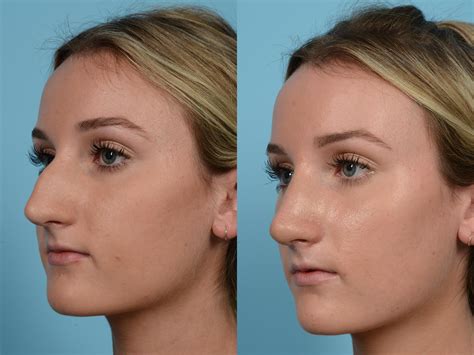 Functional Rhinoplasty: Improving Breathing and Aesthetics