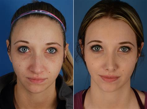 The Psychological Impact of Rhinoplasty Surgery