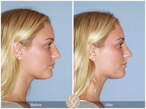 Functional Rhinoplasty: Improving Breathing and Aesthetics