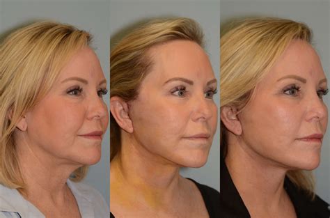 Facelift Surgery: What You Need to Know