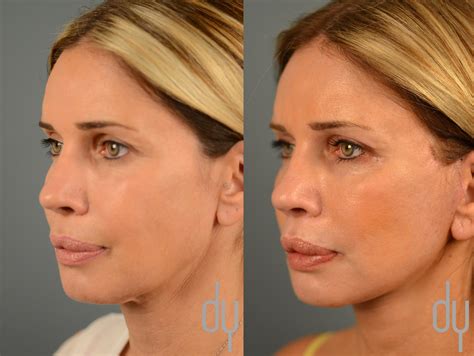 Facelift Surgery: What You Need to Know