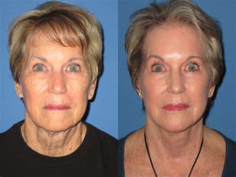 Facelift Surgery: What You Need to Know