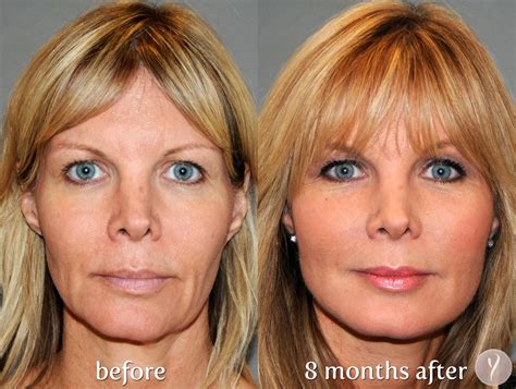 Facelift Surgery: What You Need to Know