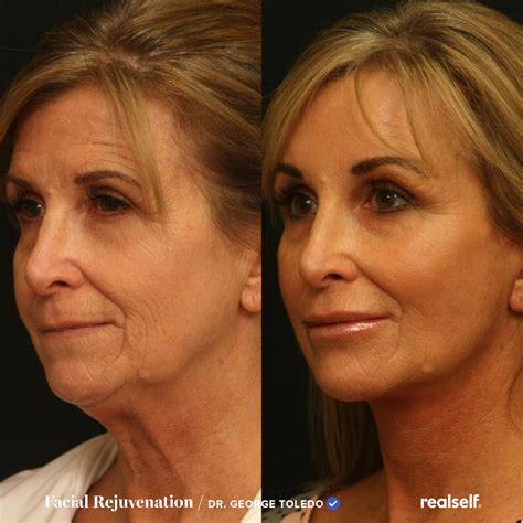Facelift Surgery: What You Need to Know