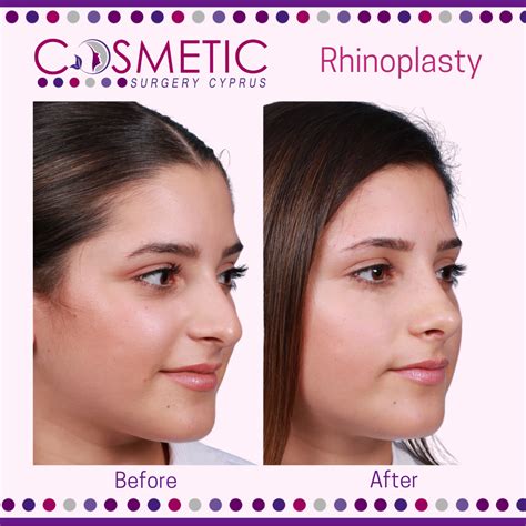 The Benefits of Ultrasonic Rhinoplasty