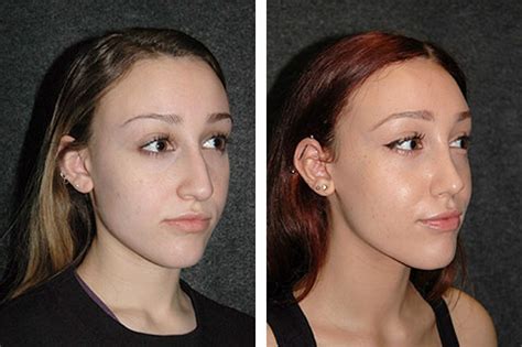 The Benefits of Ultrasonic Rhinoplasty