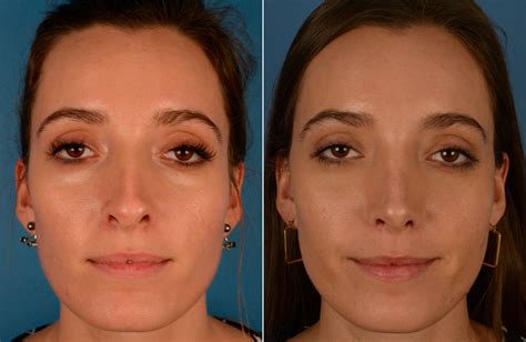 Functional Rhinoplasty: Improving Breathing and Aesthetics