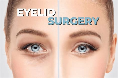Understanding the Risks and Benefits of Blepharoplasty (Eyelid Surgery)